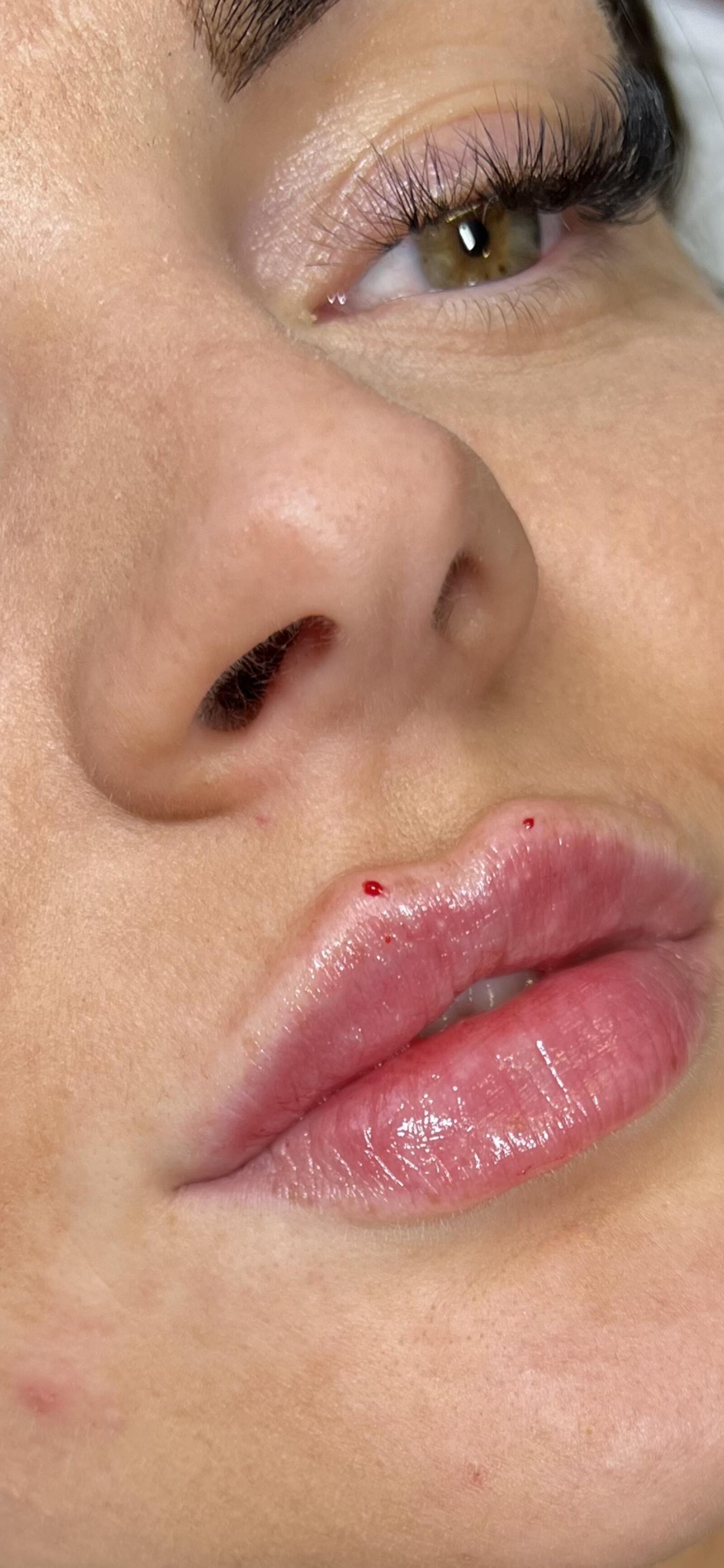 Close-up of freshly treated lips after lip filler at FACES by Alice