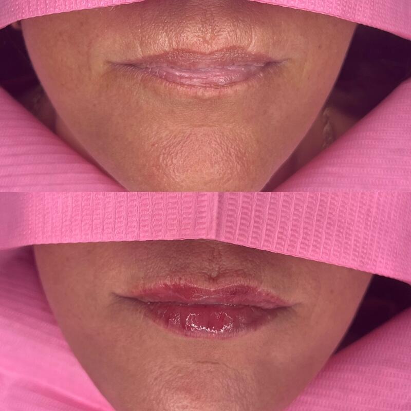 Lip filler at FACES by Alice: before (top) and after (bottom), result 1