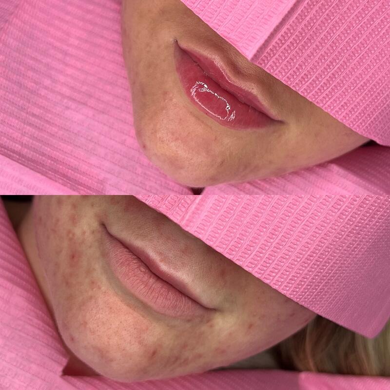 Lip filler at FACES by Alice: before (top) and after (bottom), result 2