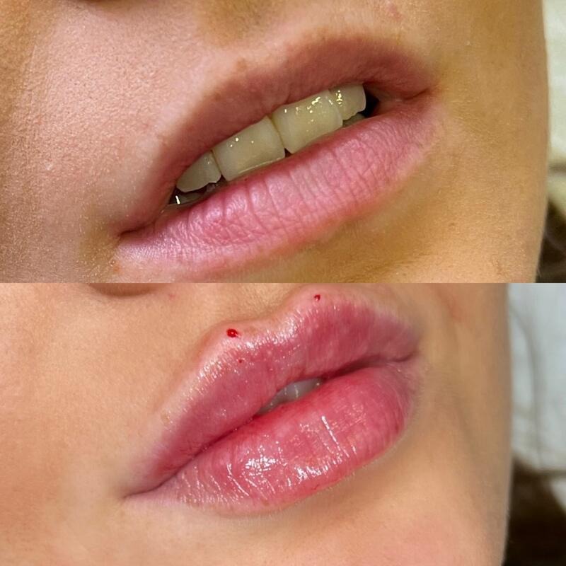 Lip filler at FACES by Alice: before (top) and after (bottom), result 3